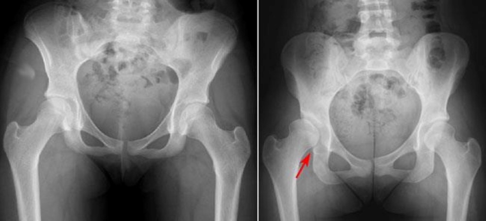 x-rays of normal hip anatomy and a dysplastic hip