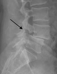 X-ray showing spondylolisthesis