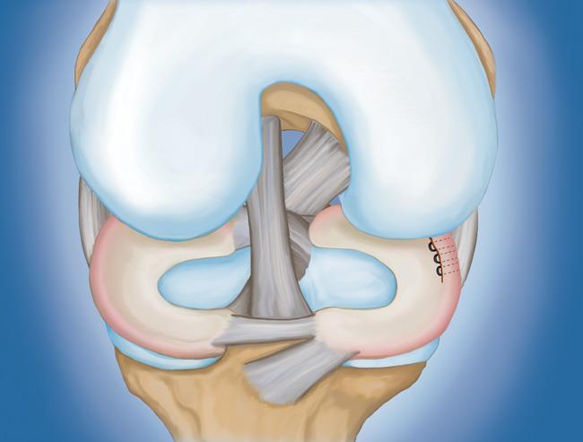 A torn meniscus repaired with sutures 