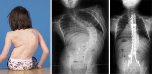 spinal fusion for child with myelomeningcele and scoliosis